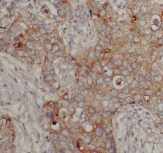 Immunohistochemistry: TRIP1 Antibody - BSA Free [NBP3-46584] - Immunohistochemistry of paraffin-embedded human breast cancer using (TRIP1 antibody) at dilution of 1:100