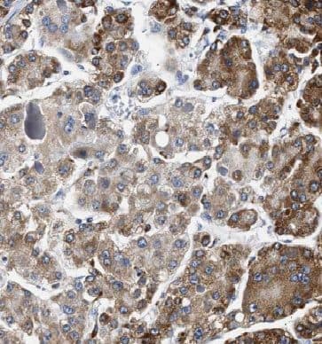 Immunohistochemistry: EFCAB5 Antibody - BSA Free [NBP3-46596] - Immunohistochemistry of paraffin-embedded human liver cancer slide using (EFCAB5 Antibody) at dilution of 1:50