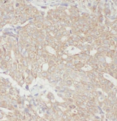 Immunohistochemistry: EEF1E1 Antibody - BSA Free [NBP3-46598] - Immunohistochemistry of paraffin-embedded human breast cancer using (EEF1E1 antibody) at dilution of 1:10