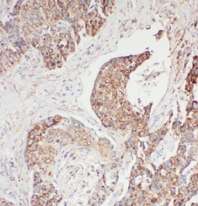 Immunohistochemistry: EDC4 Antibody - BSA Free [NBP3-46600] - Immunohistochemistry of paraffin-embedded human liver cancer using (EDC4 antibody) at dilution of 1:50