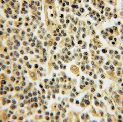 Immunohistochemistry: DYRK4 Antibody - BSA Free [NBP3-46607] - Immunohistochemistry of paraffin-embedded human lymphoma using (DYRK4 antibody) at dilution of 1:100