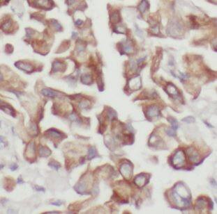 Immunohistochemistry: DUSP22 Antibody - BSA Free [NBP3-46616] - Immunohistochemistry of paraffin-embedded human lung cancer using (DUSP22 antibody) at dilution of 1:50