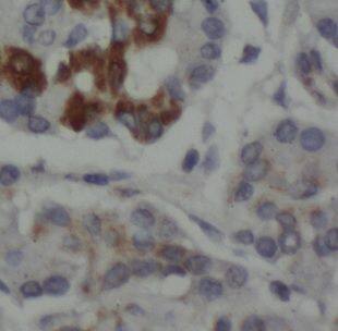 Immunohistochemistry: DUSP19 Antibody - BSA Free [NBP3-46617] - Immunohistochemistry of paraffin-embedded human pancreas cancer using (DUSP19 antibody) at dilution of 1:100