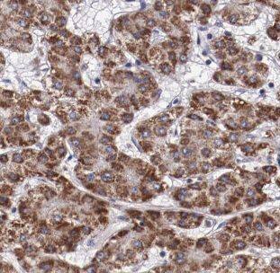 Immunohistochemistry: DUSP10 Antibody - BSA Free [NBP3-46621] - Immunohistochemistry of paraffin-embedded human liver cancer tissue slide using (DUSP10 Antibody) at dilution of 1:50