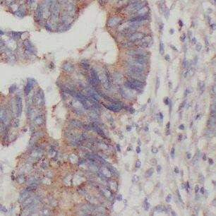 Immunohistochemistry: DTX1 Antibody - BSA Free [NBP3-46627] - Immunohistochemistry of paraffin-embedded human colon cancer using (DTX1 antibody) at dilution of 1:100