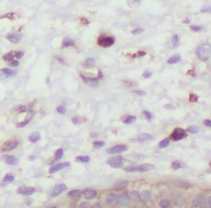 Immunohistochemistry: DXO Antibody - BSA Free [NBP3-46636] - Immunohistochemistry of paraffin-embedded human breast cancer using (DXO antibody) at dilution of 1:50
