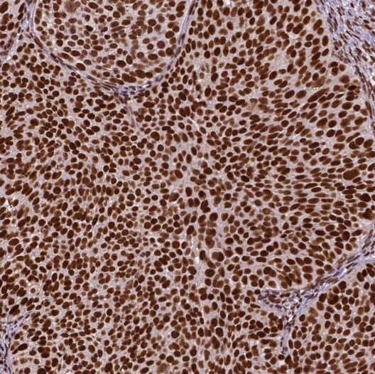 Immunohistochemistry: RPP25 Antibody - BSA Free [NBP3-46667] - Immunohistochemistry of paraffin-embedded human cervical cancer tissue slide using (RPP25 Antibody) at dilution of 1:50