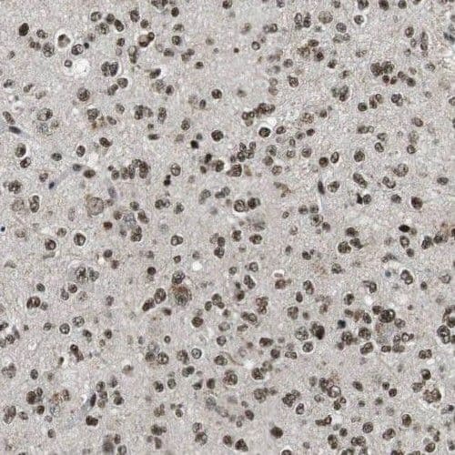 Immunohistochemistry: BLAP75 Antibody - BSA Free [NBP3-46722] - Immunohistochemistry of paraffin-embedded human gliomas using (BLAP75 antibody) at dilution of 1:100