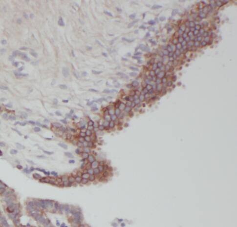 Immunohistochemistry: RERG Antibody - BSA Free [NBP3-46756] - Immunohistochemistry of paraffin-embedded human breast cancer using (RERG antibody) at dilution of 1:50