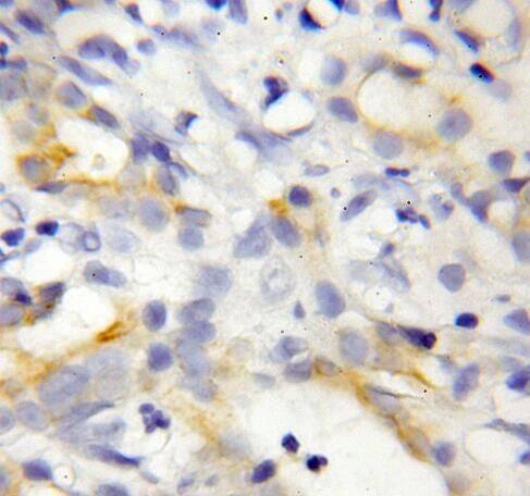 Immunohistochemistry: REEP6 Antibody - BSA Free [NBP3-46759] - Immunohistochemistry of paraffin-embedded human pancreas cancer using (REEP6 antibody) at dilution of 1:50