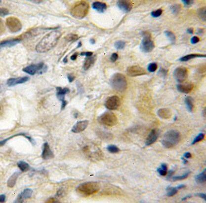 Immunohistochemistry: RECQL5 Antibody - BSA Free [NBP3-46761] - Immunohistochemistry of paraffin-embedded human pancreas cancer using (RECQL5 antibody) at dilution of 1:50