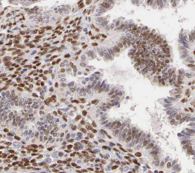 Immunohistochemistry: RBM41 Antibody - BSA Free [NBP3-46780] - Immunohistochemistry of paraffin-embedded human endometrial cancer using (RBM41 antibody) at dilution of 1:100