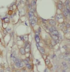 Immunohistochemistry: MOG1 Antibody - BSA Free [NBP3-46801] - Immunohistochemistry of paraffin-embedded human colon cancer using (MOG1 antibody) at dilution of 1:100
