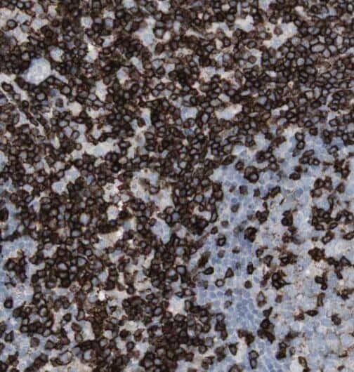 Immunohistochemistry: Rad1 Antibody - BSA Free [NBP3-46809] - Immunohistochemistry of paraffin-embedded human lymphoma using (Rad1 antibody) at dilution of 1:50