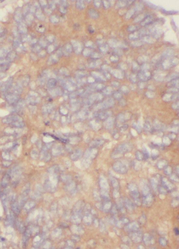 Immunohistochemistry: RAB3B Antibody - BSA Free [NBP3-46824] - Immunohistochemistry of paraffin-embedded human colon cancer using (RAB3B antibody) at dilution of 1:50