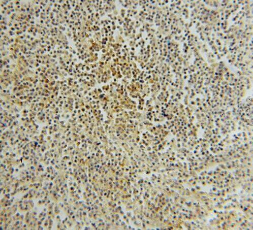Immunohistochemistry: PTPN7 Antibody - BSA Free [NBP3-46849] - Immunohistochemistry of paraffin-embedded human lymphoma using (PTPN7 antibody) at dilution of 1:100