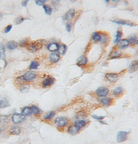 Immunohistochemistry: PTP4A1 Antibody - BSA Free [NBP3-46852] - Immunohistochemistry of paraffin-embedded human pancreas cancer using (PTP4A1 antibody) at dilution of 1:50