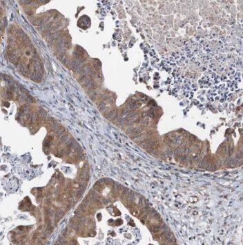 Immunohistochemistry: PTER Antibody - BSA Free [NBP3-46856] - Immunohistochemistry of paraffin-embedded human ovary tumor using (PTER antibody) at dilution of 1:50