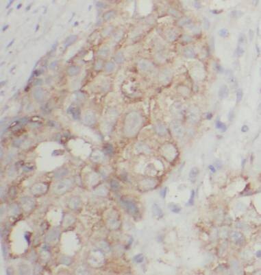 Immunohistochemistry: PRR13 Antibody - BSA Free [NBP3-46876] - Immunohistochemistry of paraffin-embedded human breast cancer tissue slide using (PRR13 Antibody) at dilution of 1:50