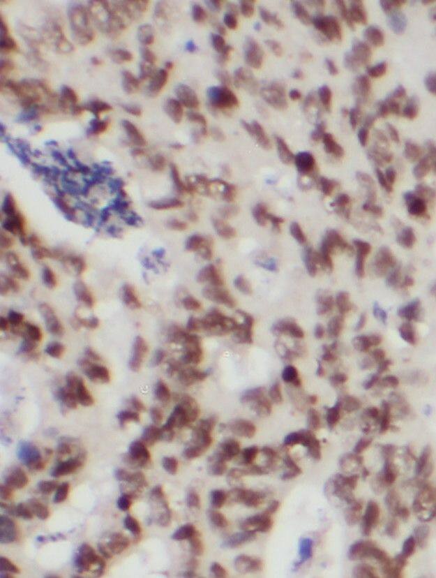 Immunohistochemistry: Protein Kinase D2 Antibody - BSA Free [NBP3-46893] - Immunohistochemistry of paraffin-embedded human colon cancer using (Protein Kinase D2 antibody) at dilution of 1:100