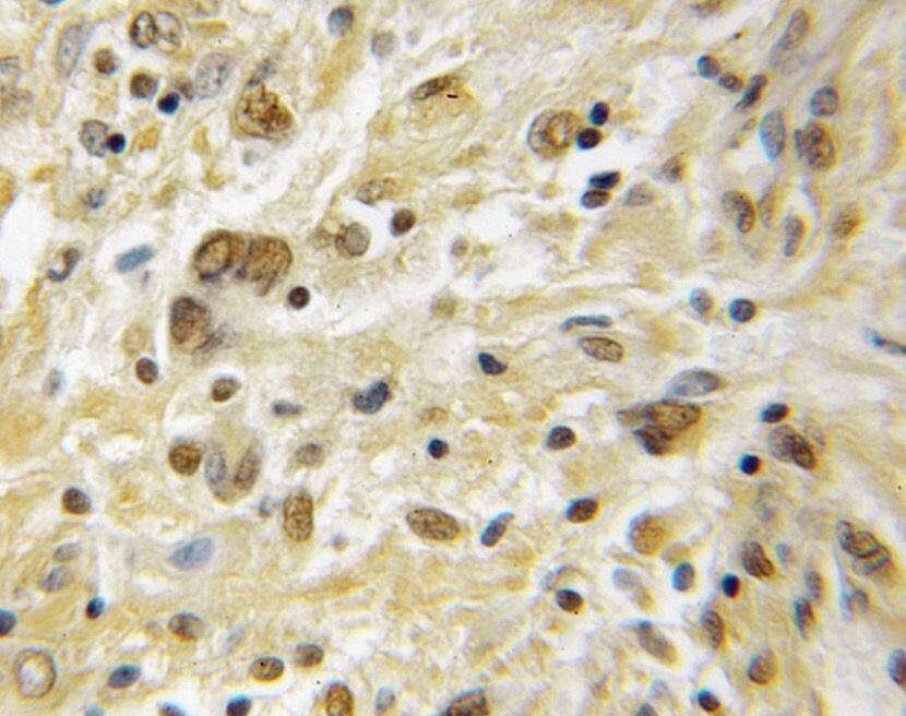 Immunohistochemistry: PKA C beta Antibody - BSA Free [NBP3-46894] - Immunohistochemistry of paraffin-embedded human medulloblastoma using (PKA C beta antibody) at dilution of 1:50