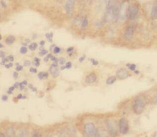 Immunohistochemistry: SSNA1 Antibody - BSA Free [NBP3-46951] - Immunohistochemistry of paraffin-embedded human colon cancer using (SSNA1 antibody) at dilution of 1:50