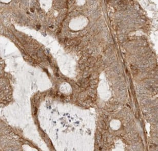 Immunohistochemistry: MYEOV Antibody - BSA Free [NBP3-46986] - Immunohistochemistry of paraffin-embedded human ovary tumor using (MYEOV antibody) at dilution of 1:50