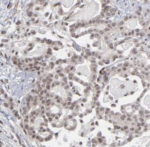 Immunohistochemistry: MYCBP Antibody - BSA Free [NBP3-46989] - Immunohistochemistry of paraffin-embedded human pancreas cancer using (MYCBP antibody) at dilution of 1:50