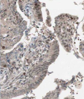 Immunohistochemistry: MSY2 Antibody - BSA Free [NBP3-47013] - Immunohistochemistry of paraffin-embedded human ovary tumor using (MSY2 antibody) at dilution of 1:50