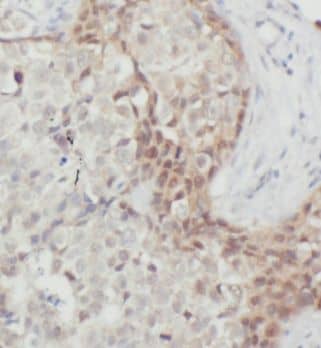 Immunohistochemistry: MRPL9 Antibody - BSA Free [NBP3-47030] - Immunohistochemistry of paraffin-embedded human breast cancer using (MRPL9 antibody) at dilution of 1:100
