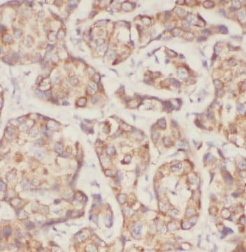 Immunohistochemistry: MRPL49 Antibody - BSA Free [NBP3-47034] - Immunohistochemistry of paraffin-embedded human breast cancer using (MRPL49 antibody) at dilution of 1:50