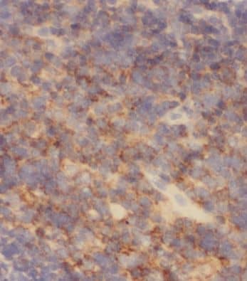 Immunohistochemistry: MRPL37 Antibody - BSA Free [NBP3-47036] - Immunohistochemistry of paraffin-embedded human lymphoma using (MRPL37 antibody) at dilution of 1:50