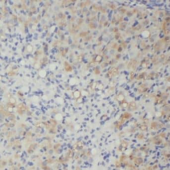 Immunohistochemistry: MPP7 Antibody - BSA Free [NBP3-47062] - Immunohistochemistry of paraffin-embedded human ovary tumor using (MPP7 antibody) at dilution of 1:100