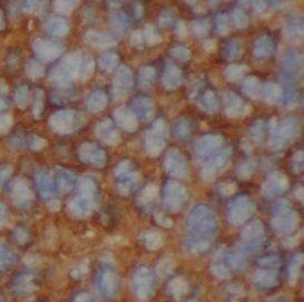 Immunohistochemistry: MOSC2 Antibody - BSA Free [NBP3-47066] - Immunohistochemistry of paraffin-embedded human liver cancer tissue slide using ( MOSC2 Antibody) at dilution of 1:200