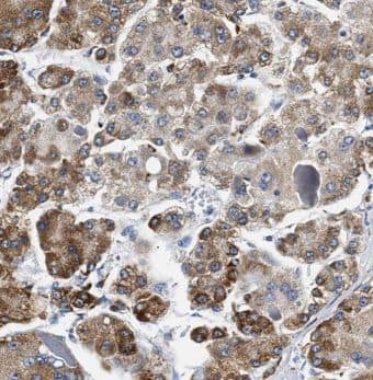 Immunohistochemistry: MOGAT1 Antibody - BSA Free [NBP3-47069] - Immunohistochemistry of paraffin-embedded human hepatocirrhosis using (MOGAT1 antibody) at dilution of 1:50