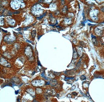 Immunohistochemistry: MN1 Antibody - BSA Free [NBP3-47077] - Immunohistochemistry of paraffin-embedded human breast cancer using (MN1 antibody) at dilution of 1:50