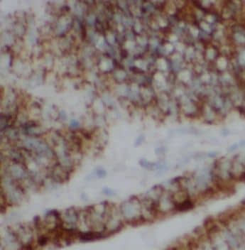 Immunohistochemistry: UEV2 Antibody - BSA Free [NBP3-47078] - Immunohistochemistry of paraffin-embedded human colon cancer using (UEV2 antibody) at dilution of 1:100