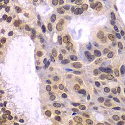 Immunohistochemistry: POLD3 Antibody - BSA Free [NBP3-47097] - Immunohistochemistry of paraffin-embedded human oophoroma using ( POLD3 Antibody) at dilution of 1:100