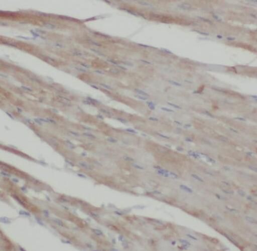 Immunohistochemistry: Pleckstrin-2 Antibody - BSA Free [NBP3-47122] - Immunohistochemistry of paraffin-embedded human pancreas cancer using (Pleckstrin-2 antibody) at dilution of 1:50