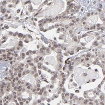 Immunohistochemistry: PLCD4 Antibody - BSA Free [NBP3-47123] - Immunohistochemistry of paraffin-embedded human pancreas cancer using (PLCD4 antibody) at dilution of 1:50