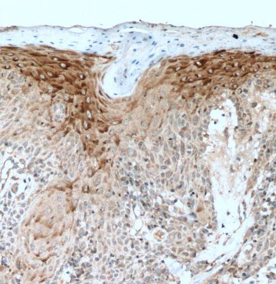 Immunohistochemistry: PLA2G4D Antibody - BSA Free [NBP3-47133] - Immunohistochemistry of paraffin-embedded human skin cancer tissue slide using (PLA2G4D Antibody) at dilution of 1:200 heat mediated antigen retrieved with Tris-EDTA buffer(PLA2G4D