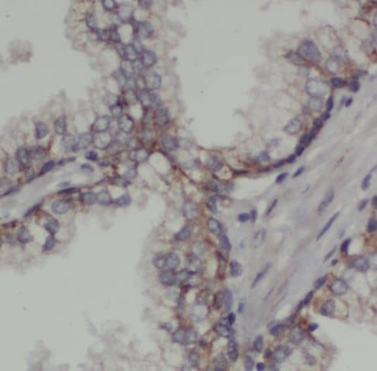 Immunohistochemistry: PIGB Antibody - BSA Free [NBP3-47150] - Immunohistochemistry of paraffin-embedded human prostate cancer using (PIGB antibody) at dilution of 1:50