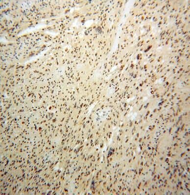 Immunohistochemistry: Pescadillo Antibody - BSA Free [NBP3-47181] - Immunohistochemistry of paraffin-embedded human gliomas using (Pescadillo antibody) at dilution of 1:100