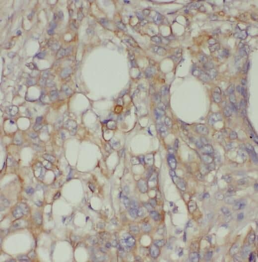 Immunohistochemistry: Proprotein Convertase 7/PCSK7 Antibody - BSA Free [NBP3-47196] - Immunohistochemistry of paraffin-embedded human colon cancer using (Proprotein Convertase 7/PCSK7 antibody) at dilution of 1:50