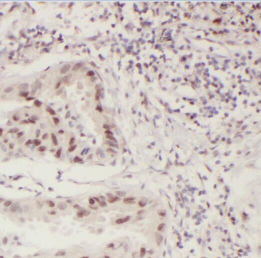 Immunohistochemistry: PCIF1 Antibody - BSA Free [NBP3-47201] - Immunohistochemistry of paraffin-embedded human lung cancer tissue slide using (PCIF1 Antibody) at dilution of 1:50