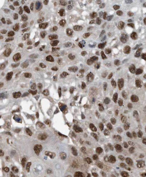 Immunohistochemistry: Pbx3 Antibody - BSA Free [NBP3-47217] - Immunohistochemistry of paraffin-embedded human lung cancer using (Pbx3 antibody) at dilution of 1:50