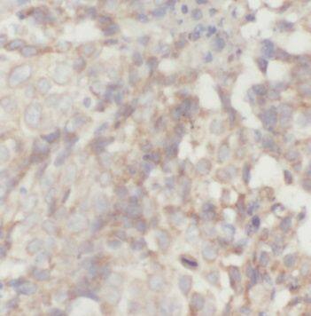 Immunohistochemistry: PACSIN2 Antibody - BSA Free [NBP3-47232] - Immunohistochemistry of paraffin-embedded human breast cancer tissue slide using (PACSIN2 Antibody) at dilution of 1:400
