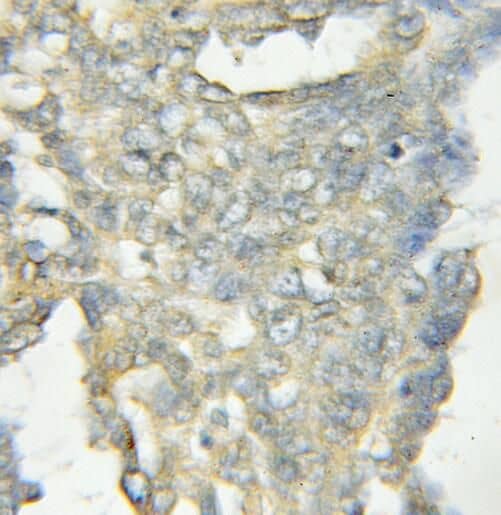 Immunohistochemistry: OSBPL11 Antibody - BSA Free [NBP3-47251] - Immunohistochemistry of paraffin-embedded human ovary tumor using (OSBPL11 antibody) at dilution of 1:50