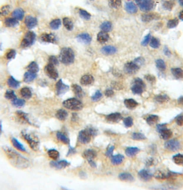Immunohistochemistry: ORC5L Antibody - BSA Free [NBP3-47253] - Immunohistochemistry of paraffin-embedded human pancreas cancer using (ORC5L antibody) at dilution of 1:50