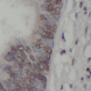 Immunohistochemistry: NXT2 Antibody - BSA Free [NBP3-47274] - Immunohistochemistry of paraffin-embedded human colon cancer using (NXT2 antibody) at dilution of 1:50